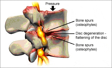Bone spurs are nasty because they pinch your nerves. 