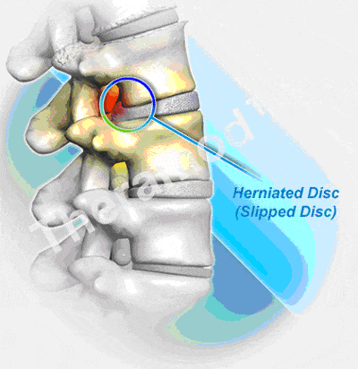 A herniated disc (slipped disc) can be reversed with our technology