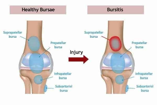 Bursa and bursitis of knee shown