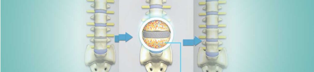 impact of therapy that reverses disc damage in patients with slip disc