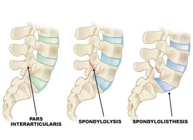 Three side views of the lower spine comparing a normal pars interarticularis, a pars crack (spondylolysis) and a crack with a forward slip (spondylolisthesis)