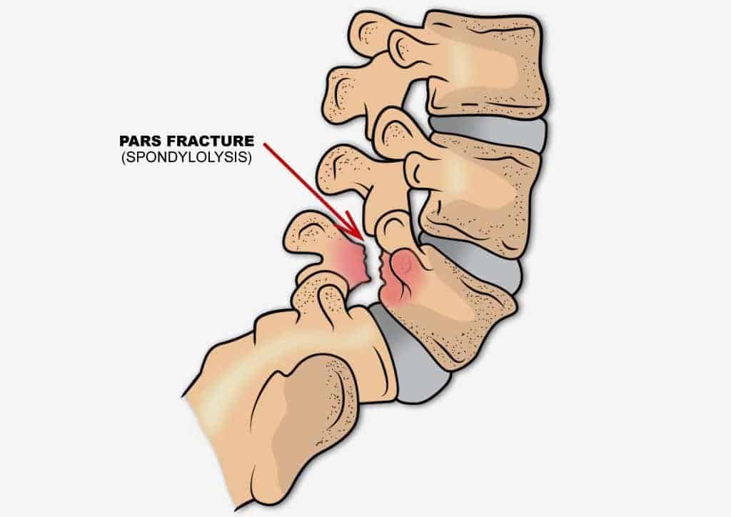 Side view of the lower spine with a crack in the pars interarticularis, labeled pars fracture (spondylolysis)