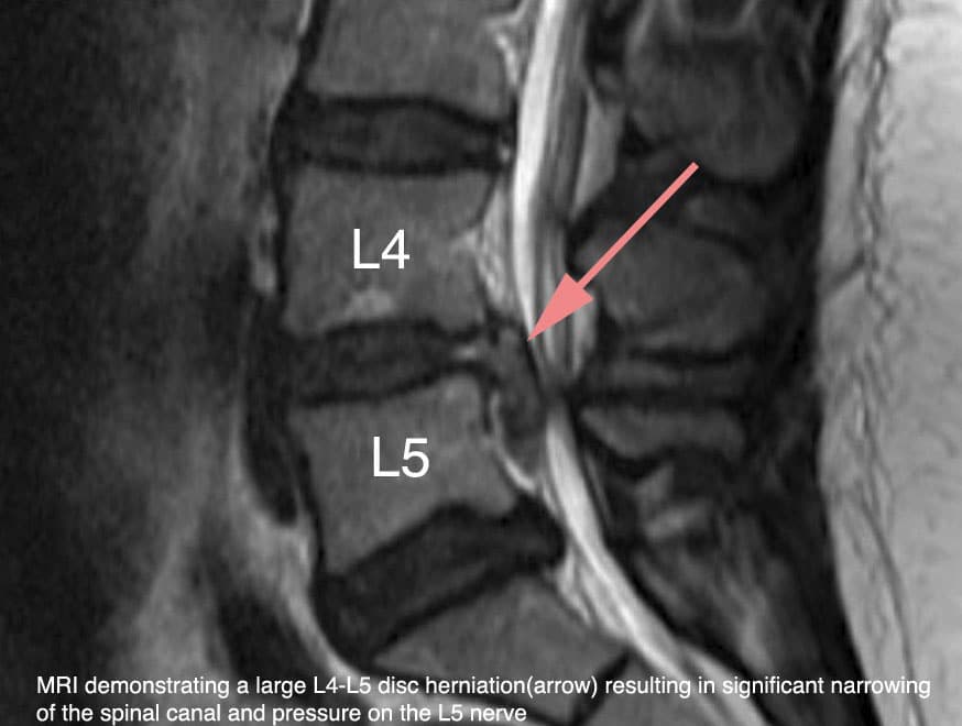 Large extruded / disc bulge at L4-L5 side view MRI