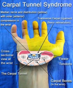 infographic on tissues and structures damaged with carpal tunnel syndrome