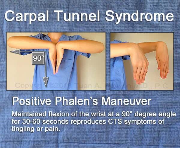 infographic on phalen maneuver for CTS