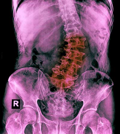 lumbar x-ray with moderate scoliosis & spondylosis