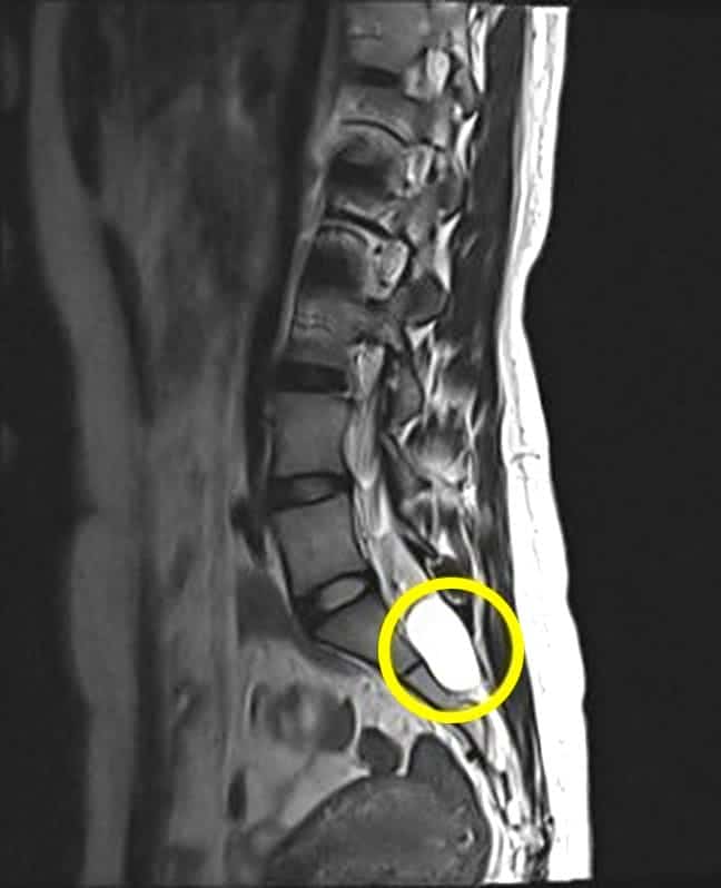 Киста в пояснице. Периневральная киста s1-s2. Арахноидальная киста позвоночника s2.