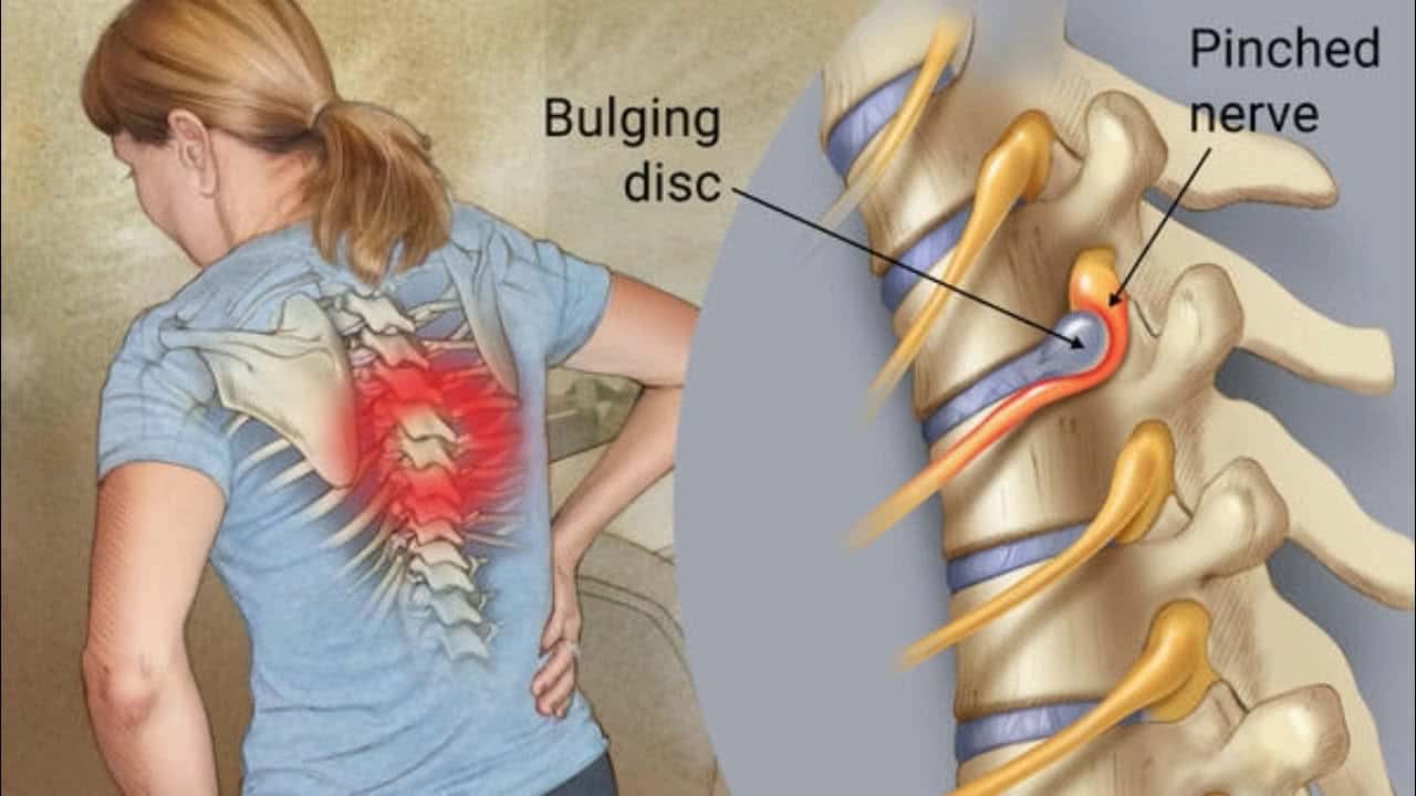 infographic showing how spondylosis pinches a nerve