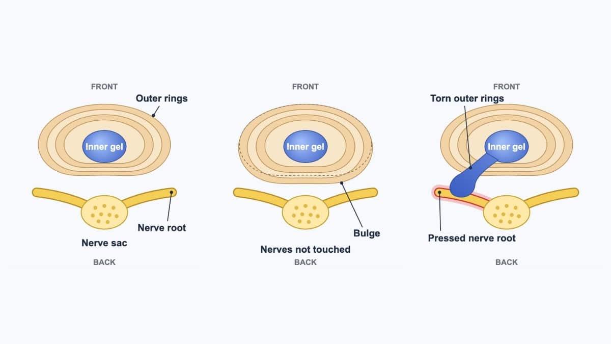 Read more about the article L2-L3 Spine: Where It Is, Disc Bulge Symptoms and Nerves