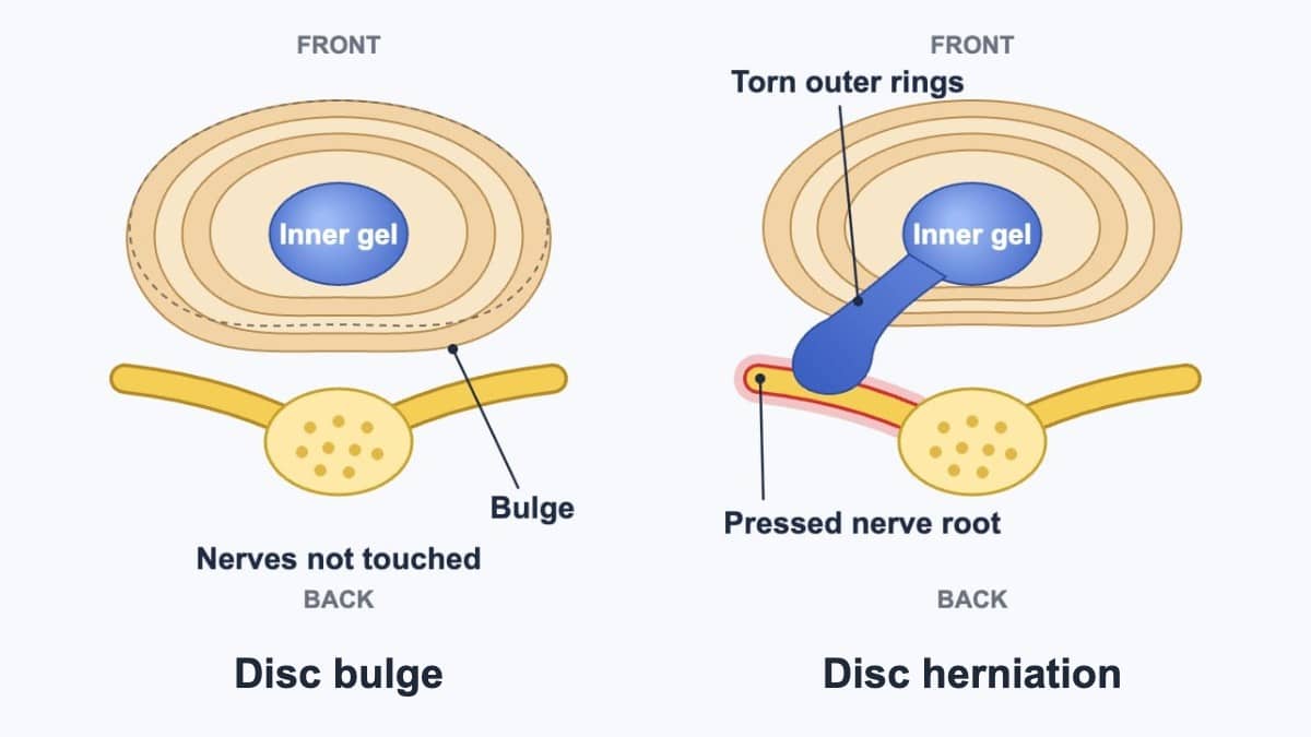 You are currently viewing L4-L5 Disc Bulge, Herniation & Treatment Without Surgery
