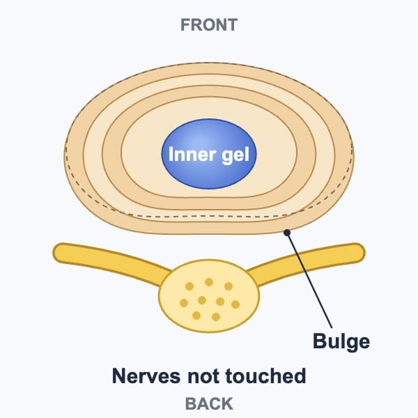Diagram of a disc bulge seen from above: the outer rings swell backward past the normal outline without touching the nerves