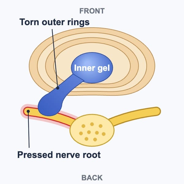 Diagram of a disc herniation seen from above: the center breaks through torn outer rings and presses on a nerve root