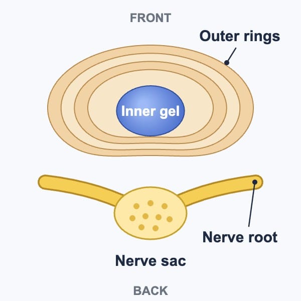 Diagram of a healthy lumbar disc seen from above: the gel-like center sits inside the outer rings, and the nerves behind the disc are untouched