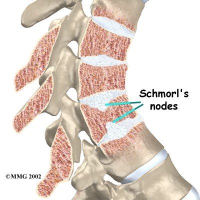 illustration of Schmorl's nodules in thoracic