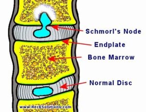 Schmorls node is disc extrusion into vertebral endplat