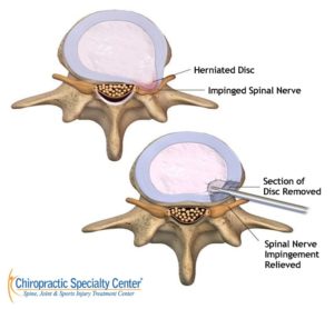 Spinal dIscectomy & laminectomy