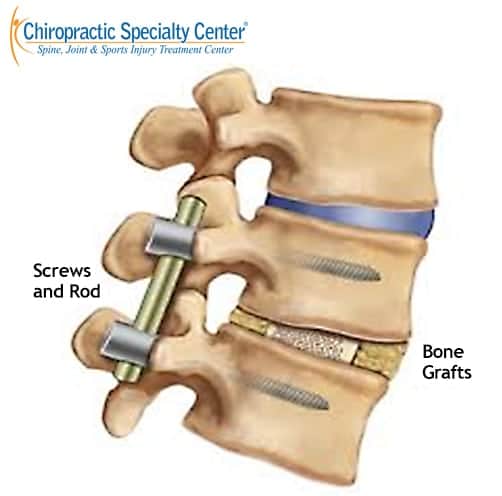 spinal fusion a closeup view