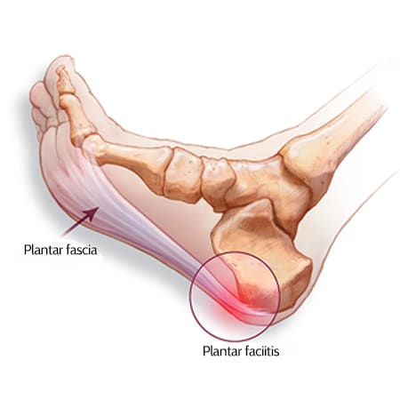 plantar fascia in flexed foot with plantar fasciitis