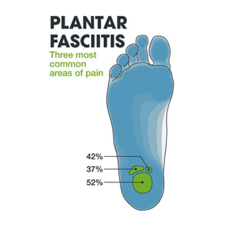 depicting most common location of plantar fascia pain