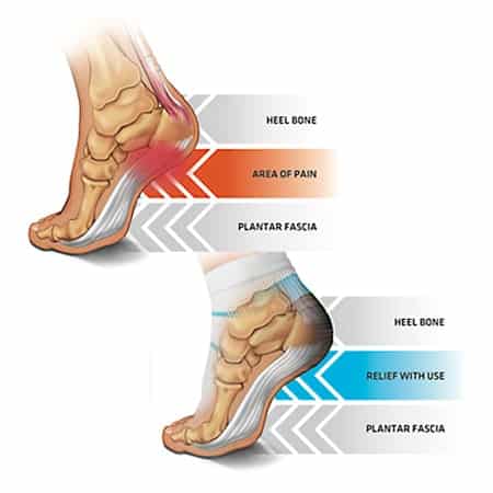showing location of heel pain with plantar fascia