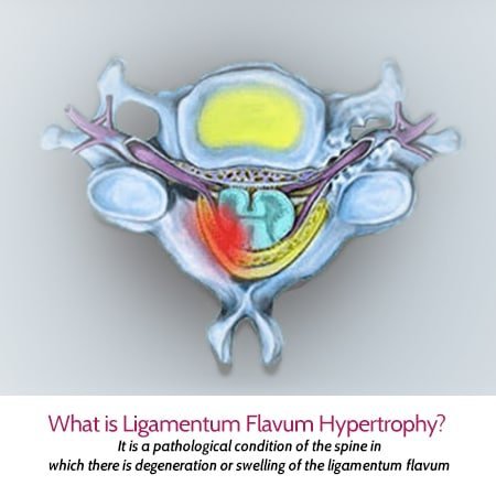 top view spinal highlight facet joint hypertrophy
