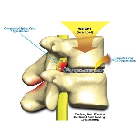 axial loading shown as cause of facet hypertrophy and disc degeneration