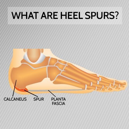 calcaneal heel spur