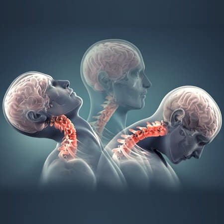 Whiplash and facet hypertrophy of the neck