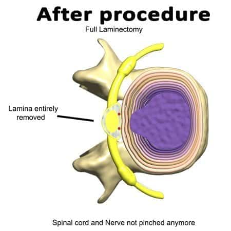 illustration of what happens after laminectomy