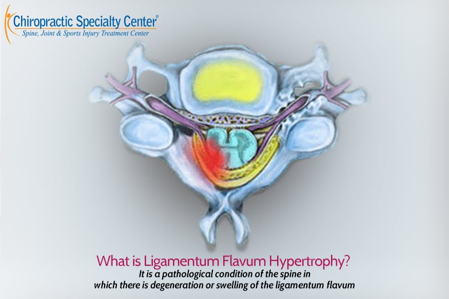 Ligamentum Flavum Hypertrophy Definition, Cause And Treatment