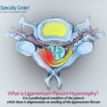 infographic on what is hypertrophy of ligamentum flavum