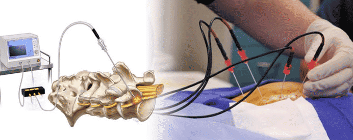 Radiofrequency (RF) Ablation Or Radiofrequency Neurotomy