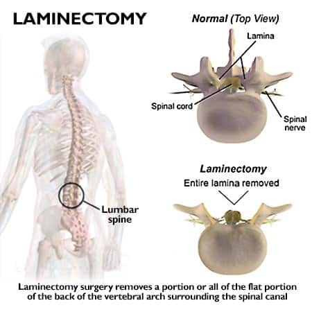 illustration of spinal laminectomy before and after surgery