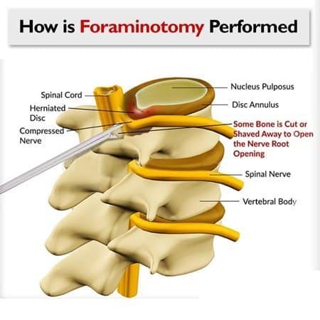 spinal foraminotomy