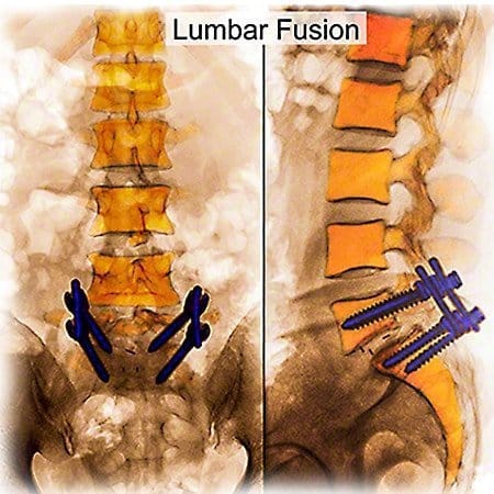 Lumbar spine fusion
