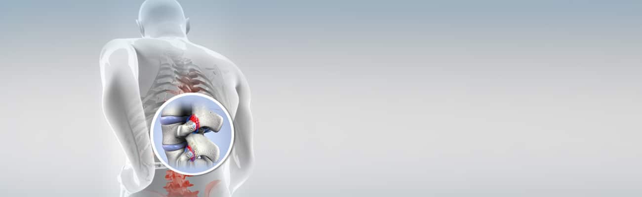 You are currently viewing Facet Hypertrophy: Understanding Causes & Support Options