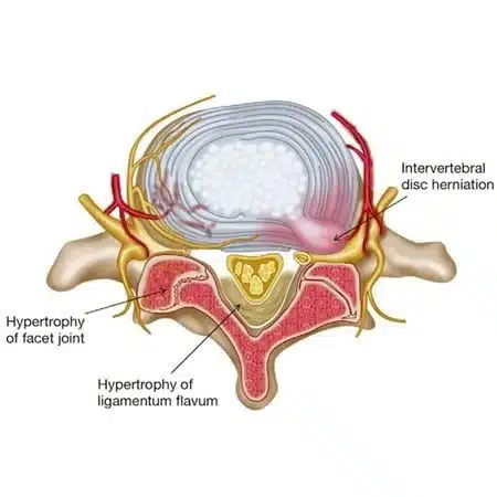 Top view of a lumbar vertebra: ligamentum flavum hypertrophy and an enlarged facet joint narrow the canal, and a disc herniation presses on a nerve root