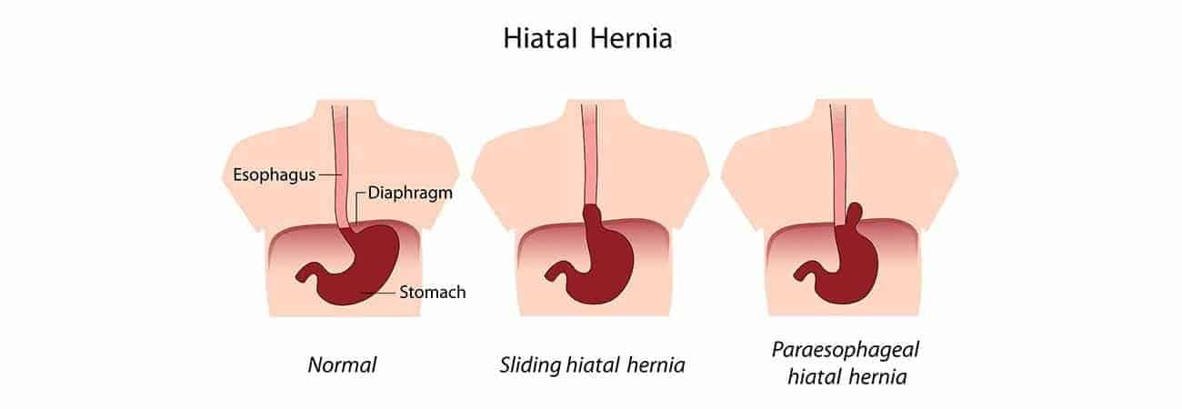 noro sliding hiatal hernia and paraesophageal hiatal hernia