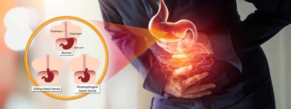 Illustration of hiatal hernia its types and causes