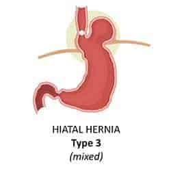 hiatal hernia type three or mixed hernia