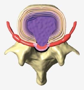 illustration of a large herniated disc