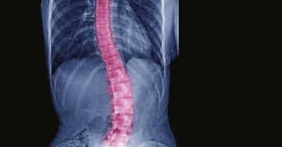 scoliosi x-ray of the spine