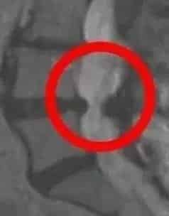 hypertrophy of ligamentum flavum on MRI