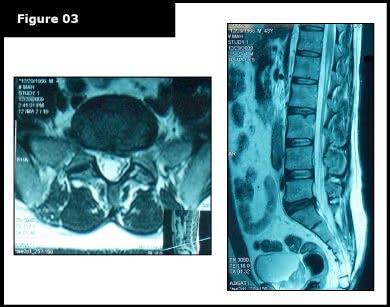 repaired slipped disc with proven slipped disc treatment