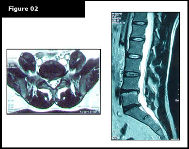 Proven slip disc treatment showing reversal of severe slipped disc