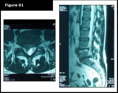 severe spinal disc herniation & extrusion