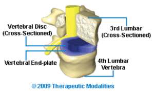Cross section of L4-L5 spinal disc & spinal Joint shown