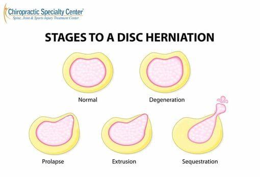 Top view of various disc issues including sequestered and fragmented disc
