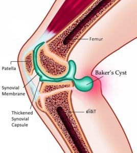 baker's cyst cause by damage to synovial membrane