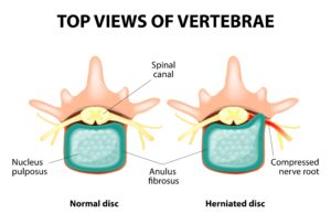 Top view of spine showing cause of upper back pain